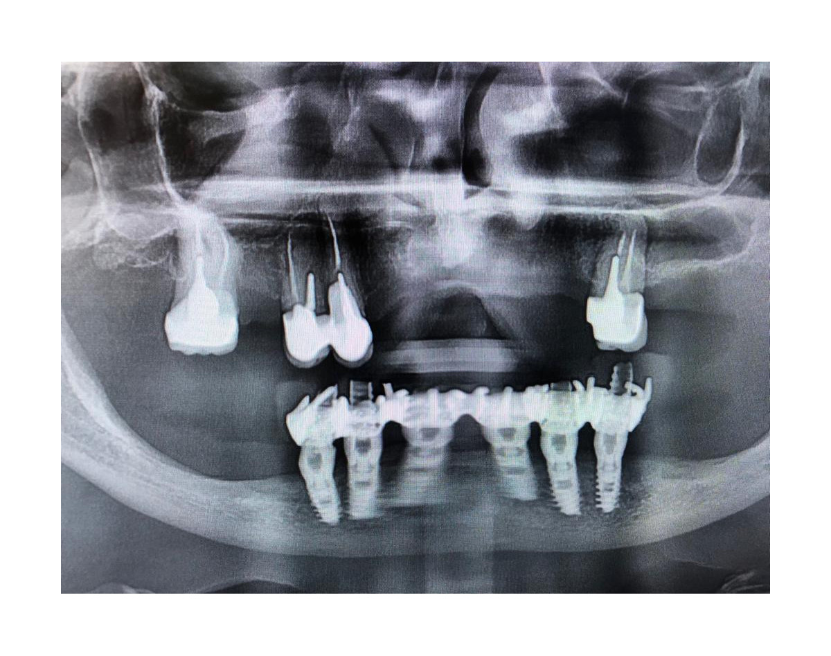 Advanced Dental Restoration